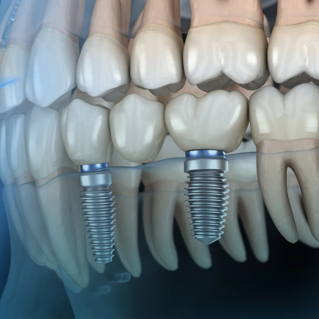 Implant supported bridges at Smile Design Team