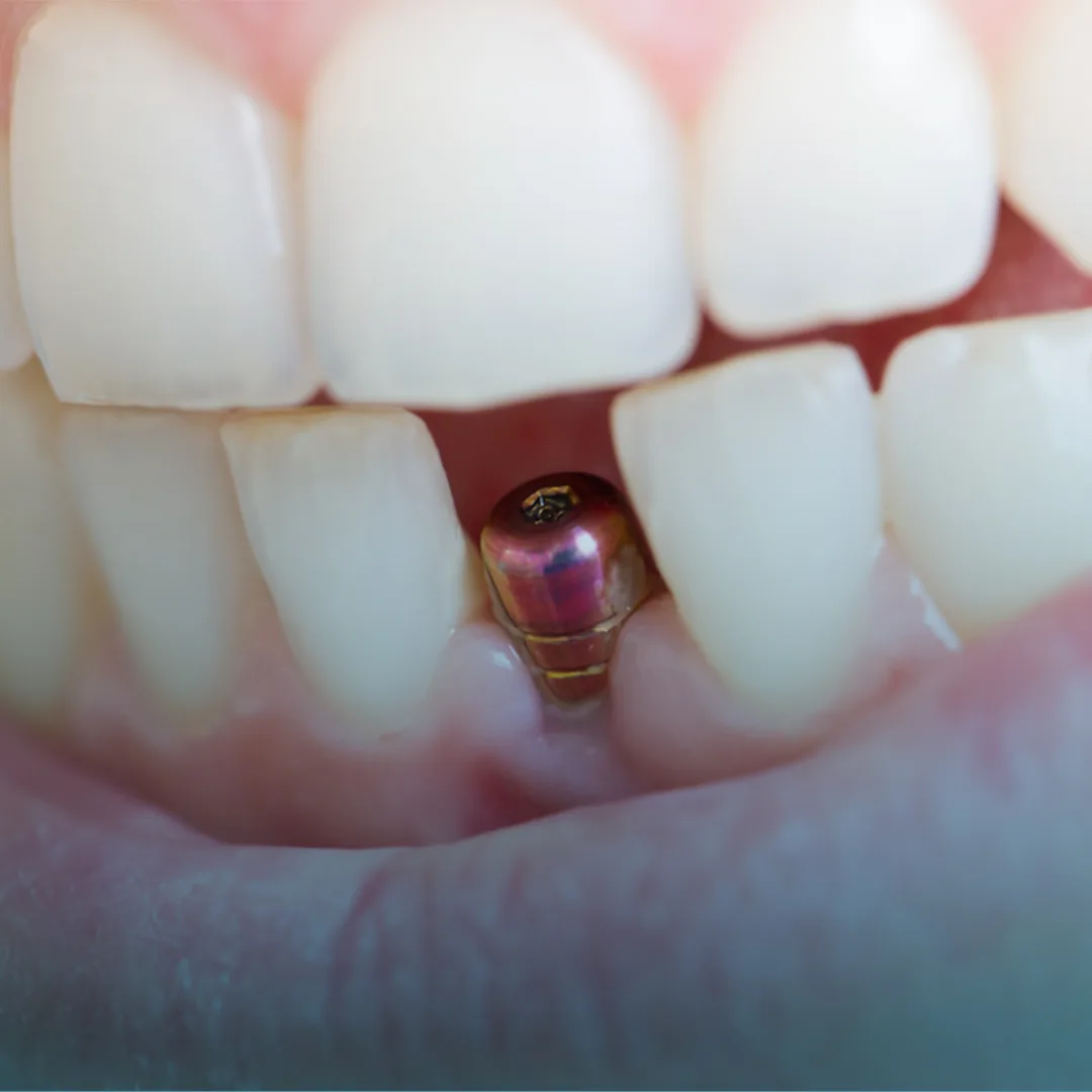 Single tooth dental implant at Smile Design Team