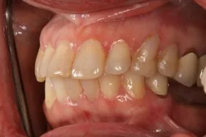 Before photo of a veneers and dental implants smile makeover case