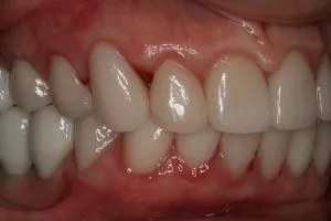 After photo of a veneers and implants cosmetic dentistry case
