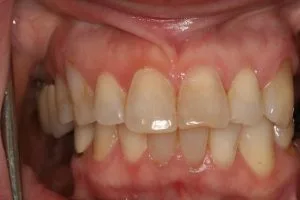 Before photo of a Smile Design Dental Team veneers and implants case