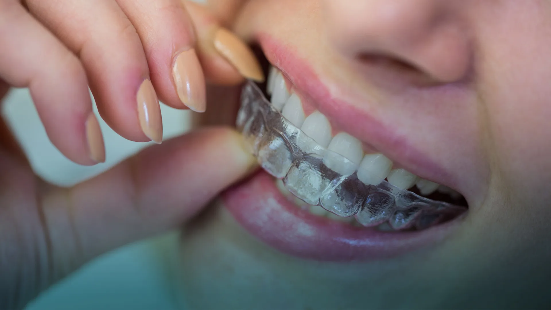 Invisalign treatment at Smile Design Team