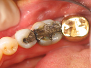 Metal-Free Dental Crowns