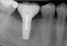 Root Canal Alternative Therapy