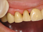 Tooth Bonding Dedham