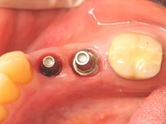 Tooth Implants Dedham MA