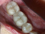 Tooth Onlays Dedham MA