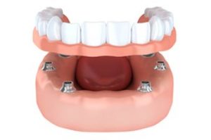 All-on-4 Dental Implants Dedham MA