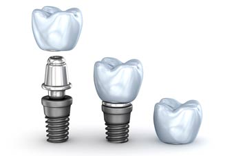 Single Tooth Implants Dedham MA