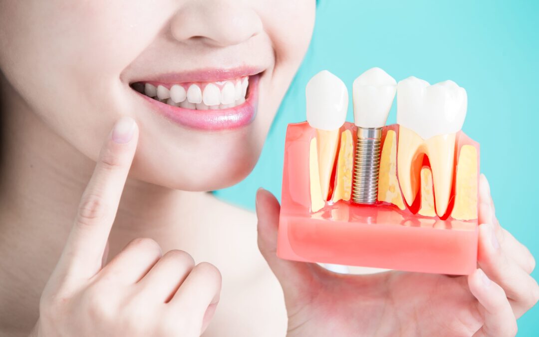 3 Signs You’re a Quality Dental Implant Candidate