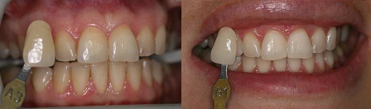 Zoom teeth whitening result from Smile Design Dental Team in Dedham